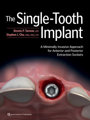 cover image of The Single-Tooth Implant